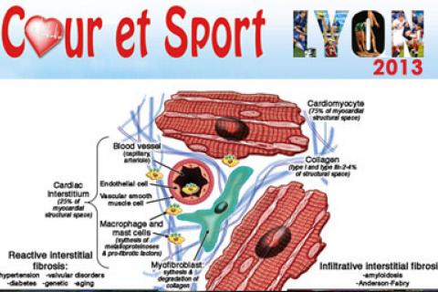 RUPTURE DE PLAQUE A L'EFFORT : RÉALITÉ OU FICTION