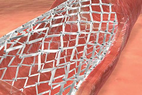 STENTS CORONAIRE ET SPORT